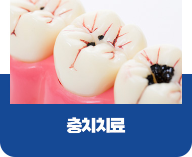 충치치료
