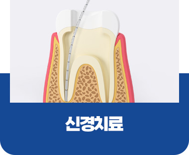 신경치료